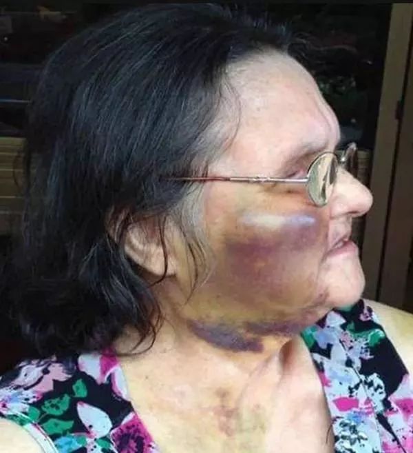"護(hù)女被打成90歲腦齡"事件震驚全國誰該為這場悲劇負(fù)責(zé)？